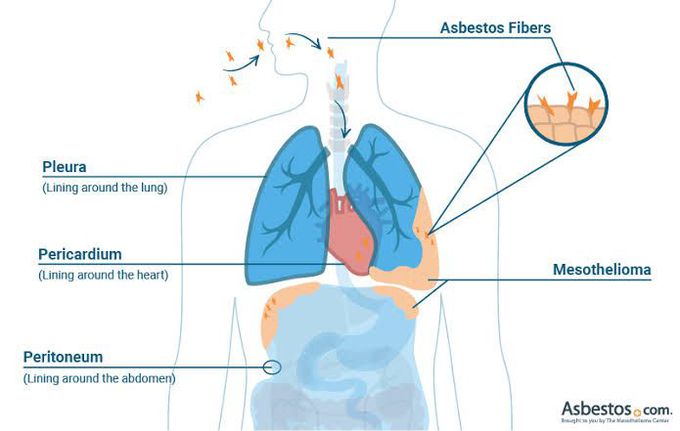 Mesothelioma