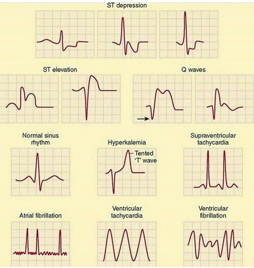 What Is An Abnormal Heart Rate