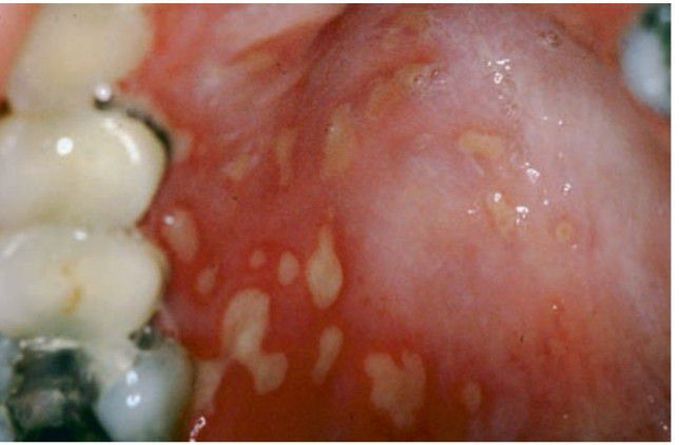 Secondary Herpes simplex infection