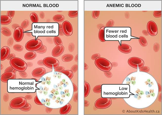 What Is Anemia Medizzy 6880