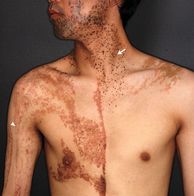 Phakomatosis Pigmentokeratotica