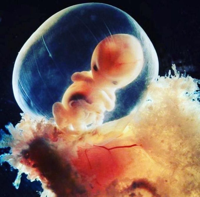 Fetus surrounded by amniotic cavity