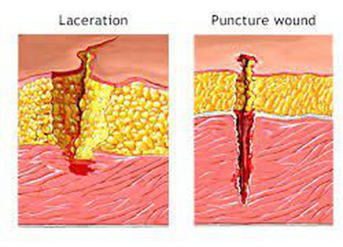 Laceration