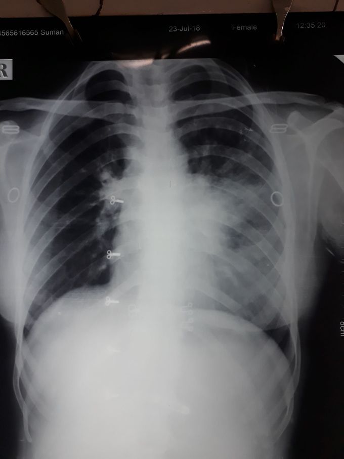 23 yr old female cough fever DOE 2 weeks