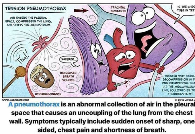 Tension pneumothorax