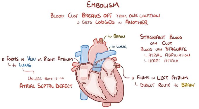 Atrial septal defect
