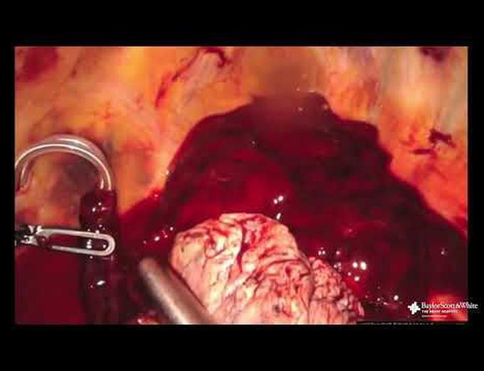 Robot-Assisted Evacuation of Hemothorax