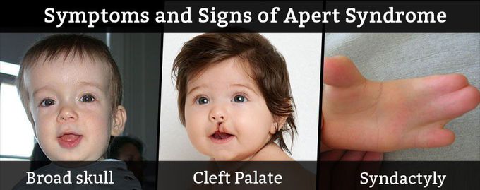 Symptoms of Apert syndrome