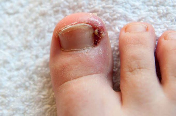 Ingrown toe nail