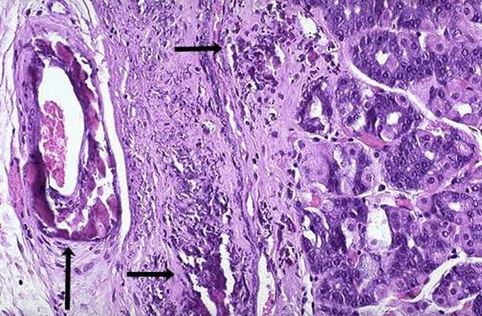 Dystrophic calcification