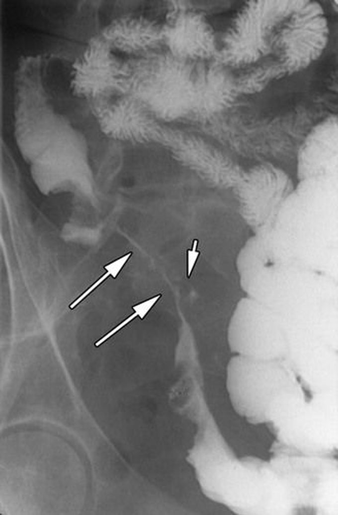 String Sign in Crohn's Disease - MEDizzy