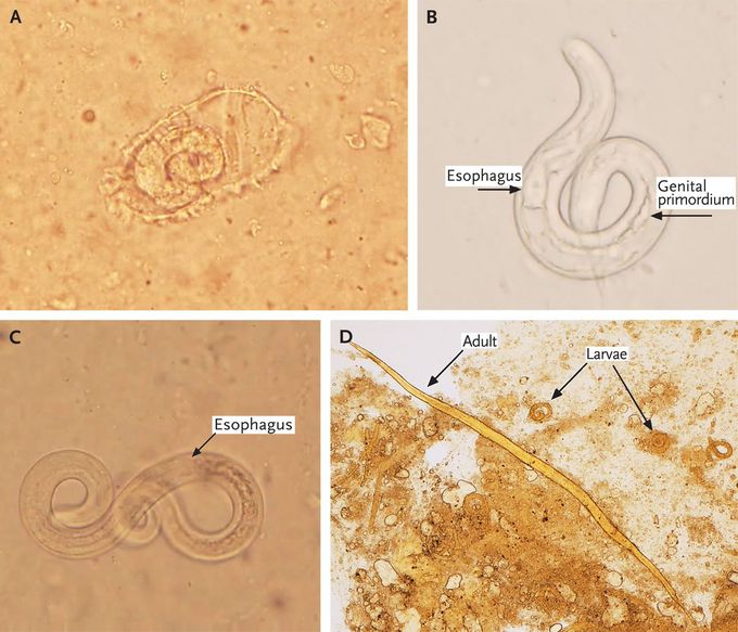 Strongyloides stercoralis Embryonated Ova in the Lung