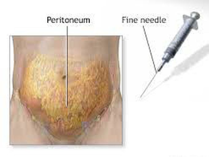 Treatment for peritonitis