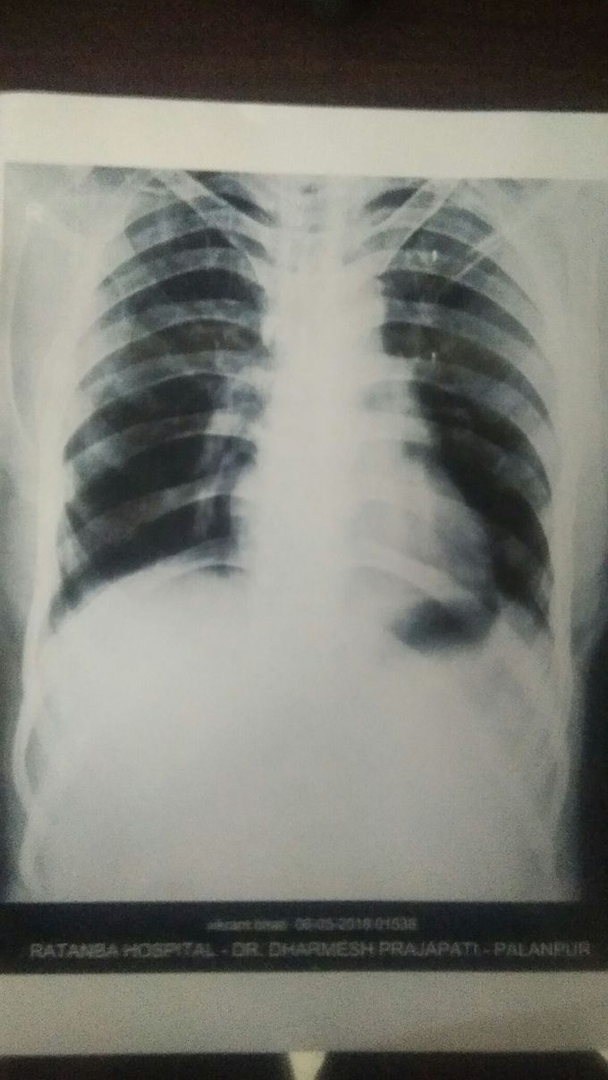 Chest X-ray And Left site very pain with cough suggest me