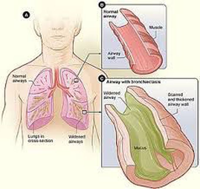 Cause of broncheictasis