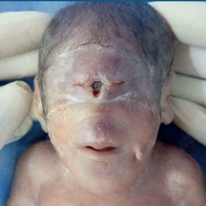 ‌Holoprosencephaly - rare birth defect
