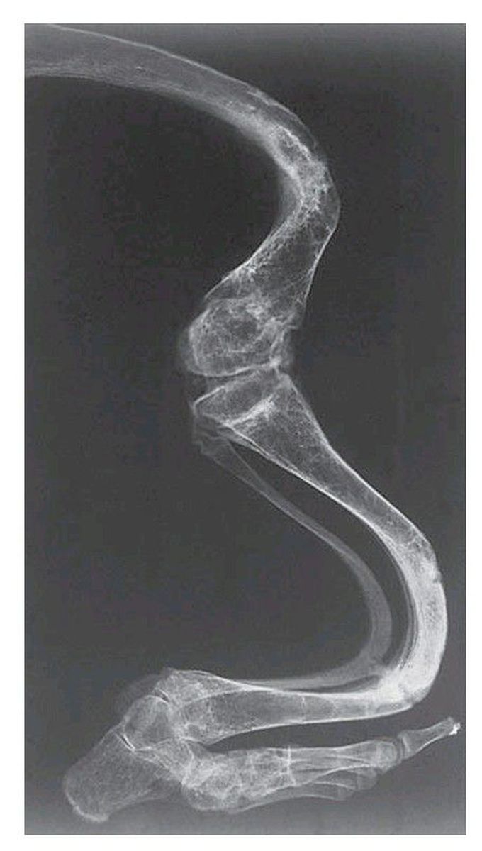 Osteogenesis imperfecta