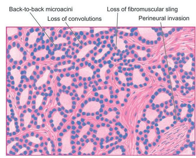 Carcinoma of the prostate.