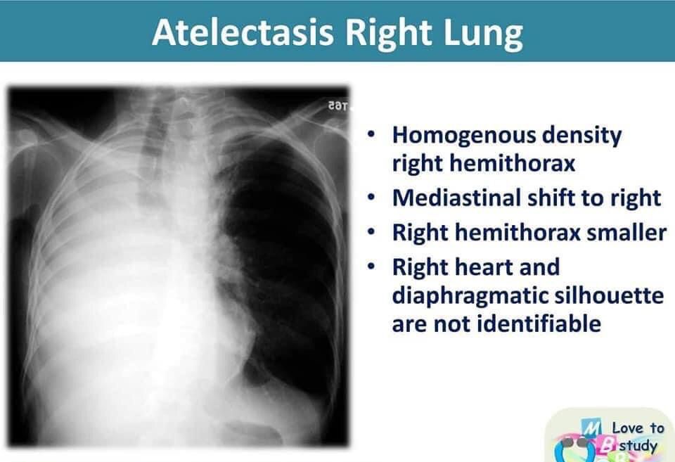 Atelectasis of right lung CXR MEDizzy