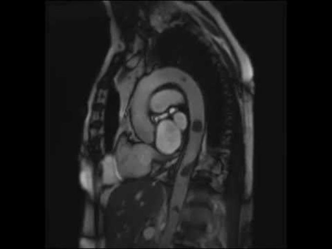 Intraaortic Thrombi Moving in Synchrony with the Cardiac Cycle