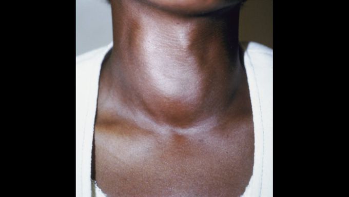 what is Goiter?