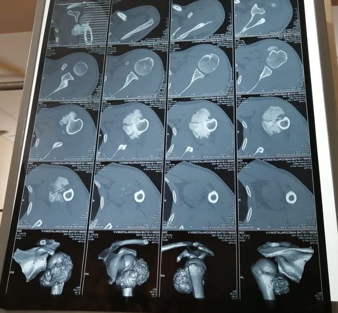 Bone tumor