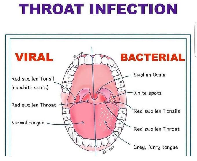 Throat infection