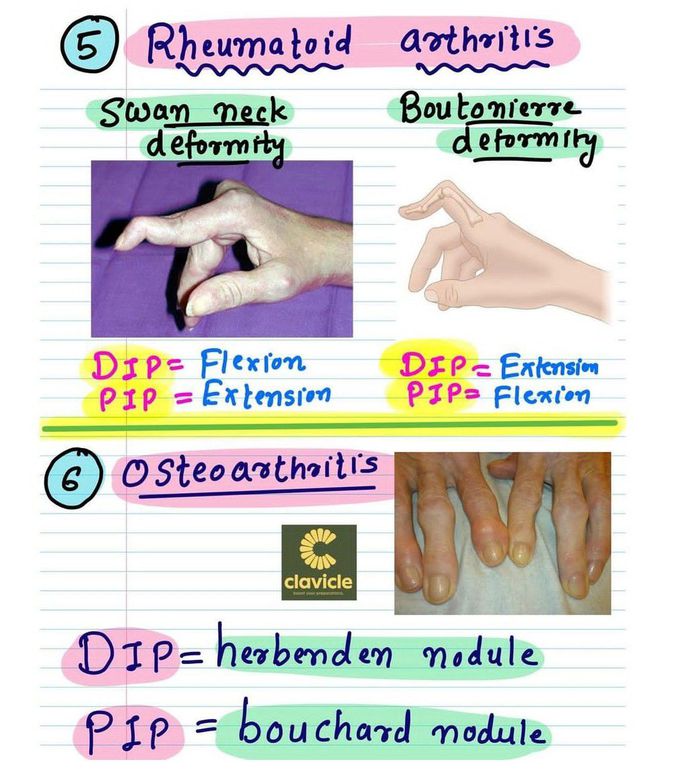 Bone Deformities