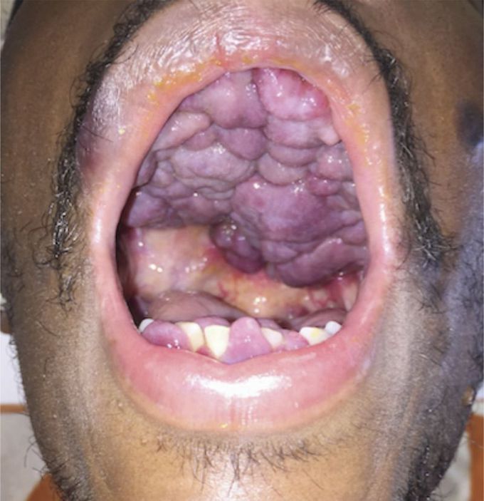Kaposi’s Sarcoma of the Oral Cavity