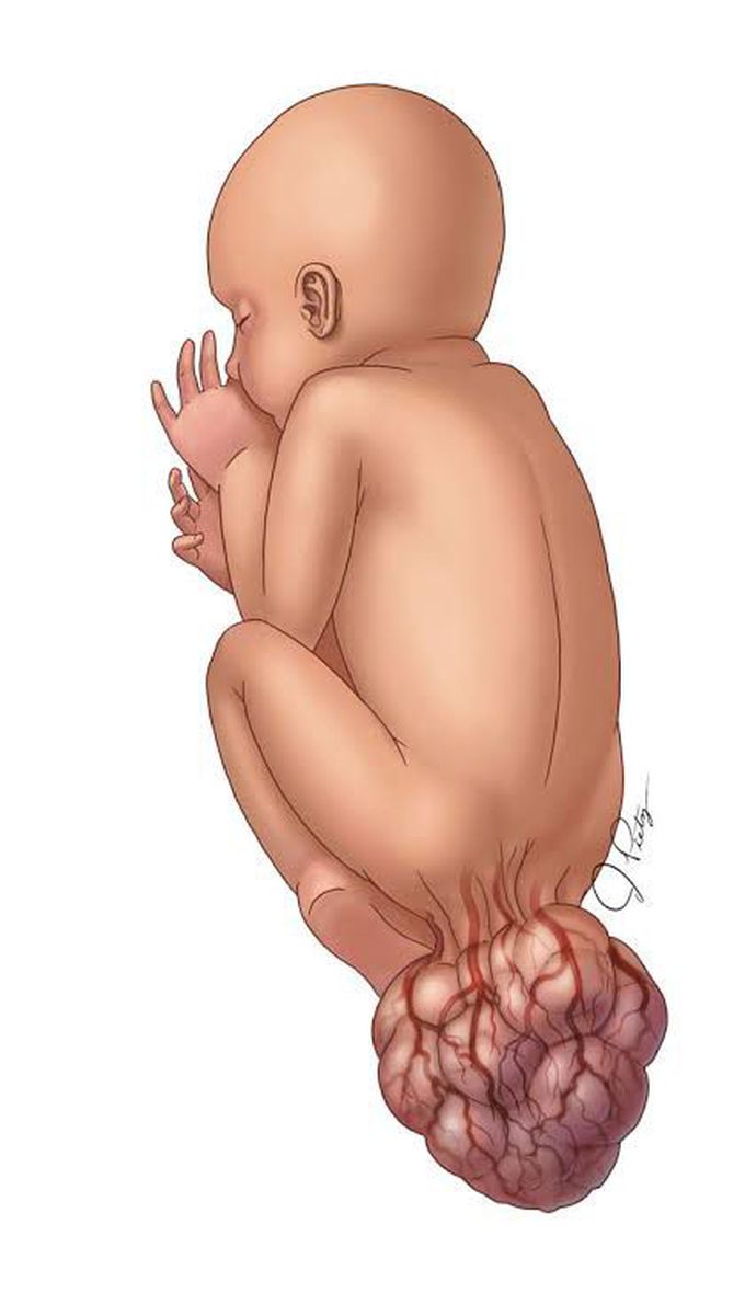 Saccrococcygeal teratoma