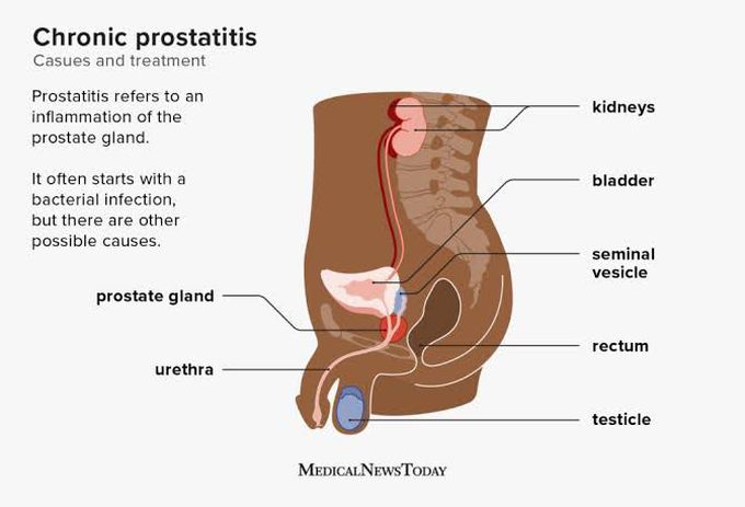 Chronic Bacterial Prostatitis