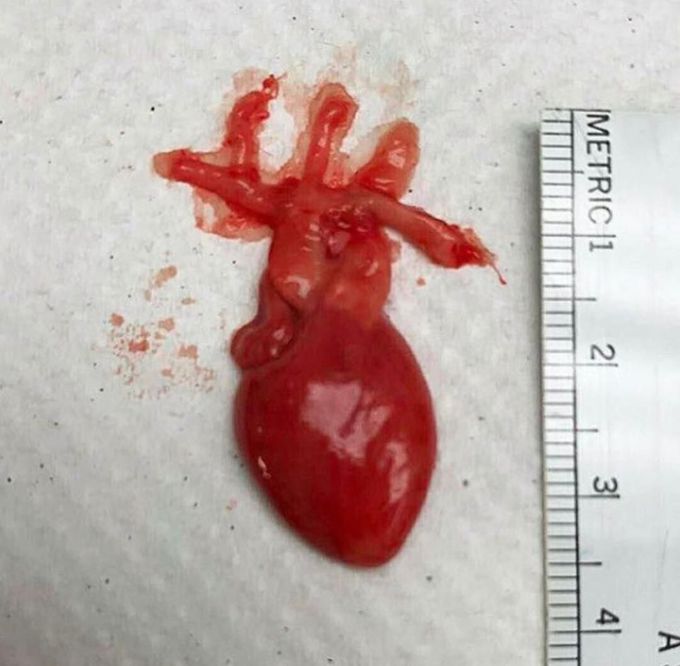 Fetal heart with aortic arch and its branches