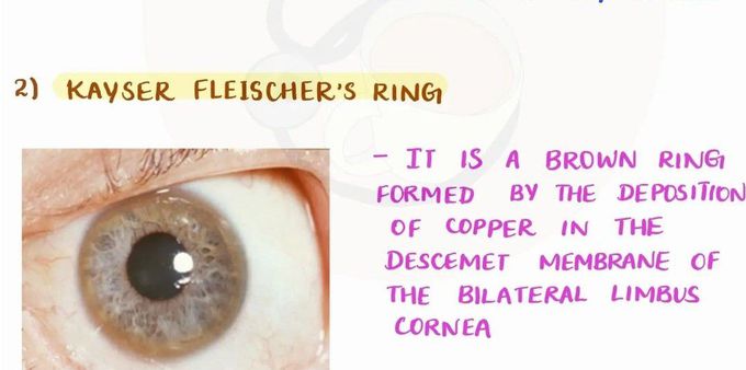 Kayser Fleischer's Ring