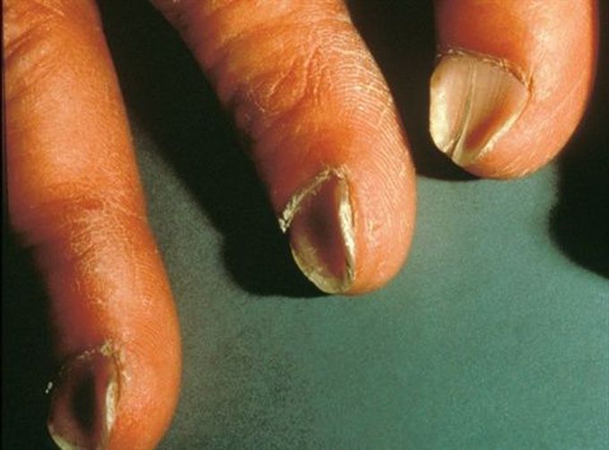 Spooning of the nail