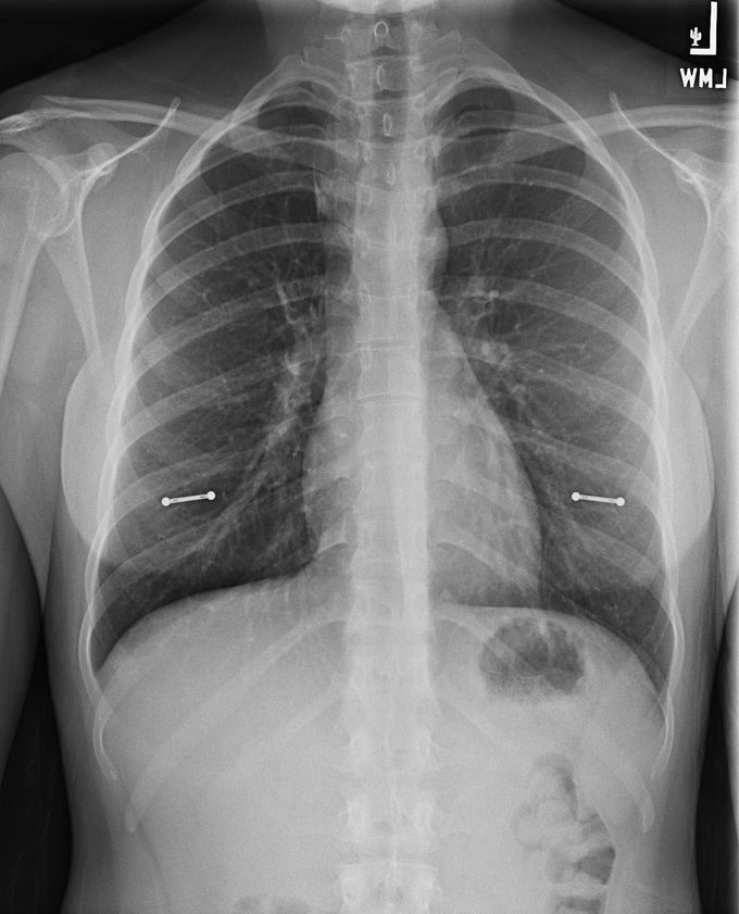 Foreign body on an X-ray