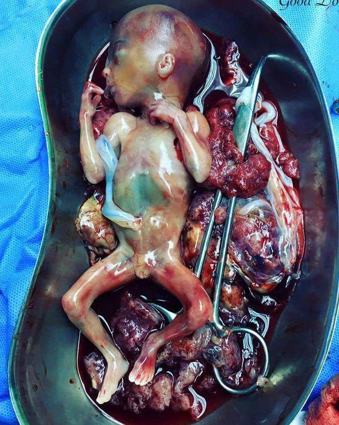 Premature birth 😶