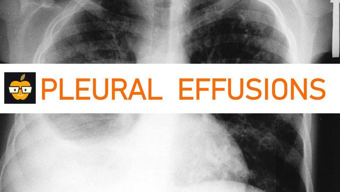 Light's Critera | Transudative vs. Exudative Pleural Effusions
