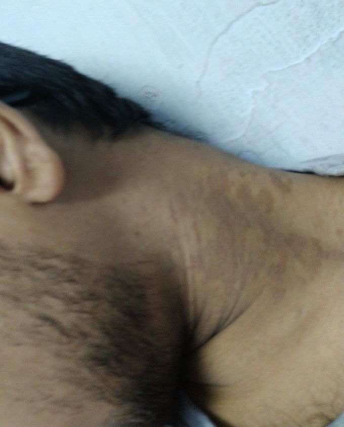 Light red rash on one side of the neck