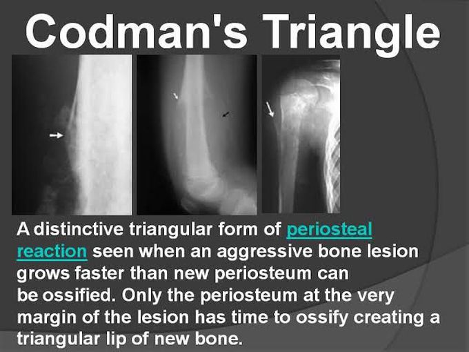 Codman's Triangle