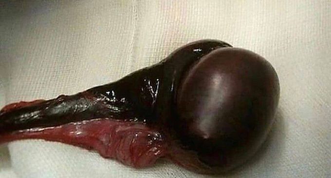 Testicular Necrosis due to Testicular Torsion