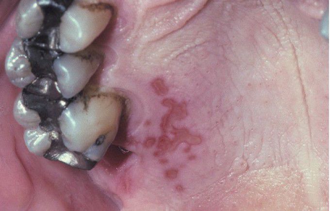 Intraoral Recurrent Herpetic Infection