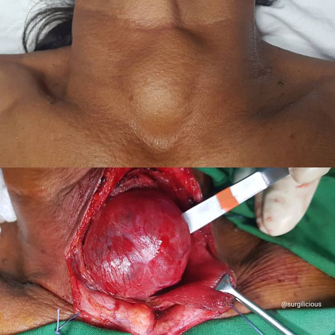 Thyroid cyst