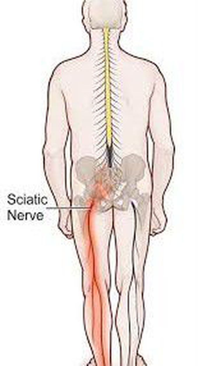 Causes of sciatica