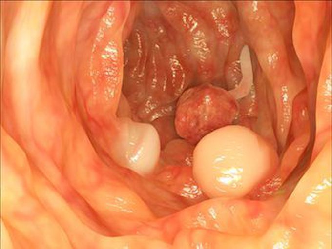 Colorectal Carcinoma on Endoscopy