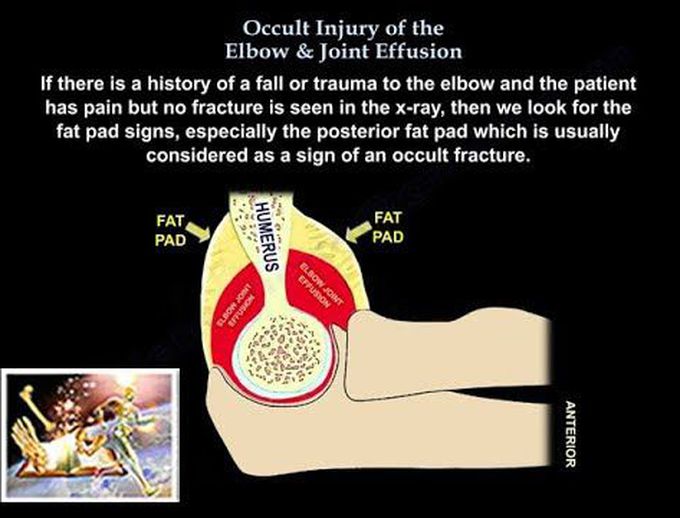 Occult Injury Of The Elbow & Joint Effusion - Everything You Need To Know - Dr. Nabil Ebraheim