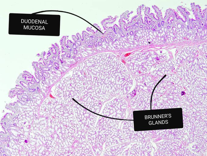 Brunner's gland adenoma
