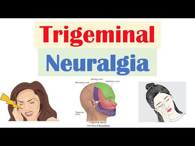 Trigeminal Neuralgia