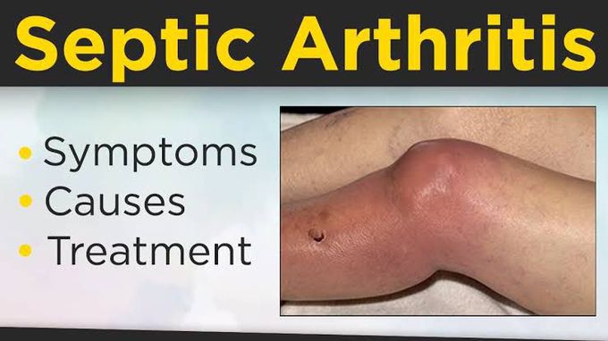 Symptoms of septic arthritis