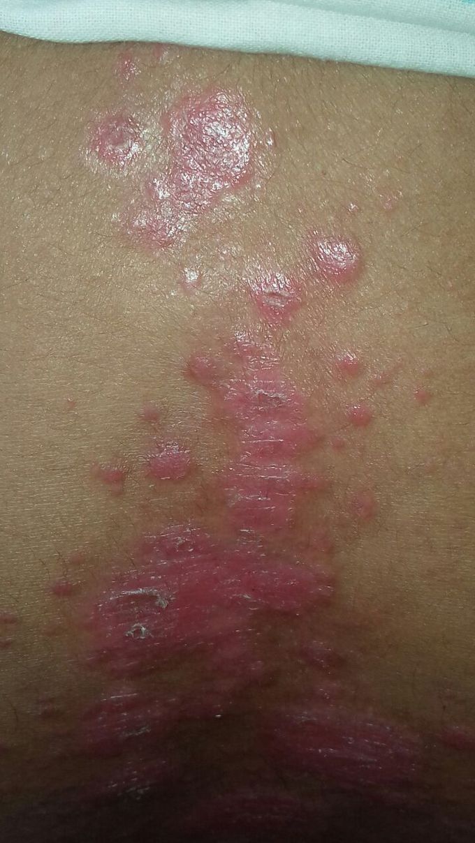 Scalp psoriasis