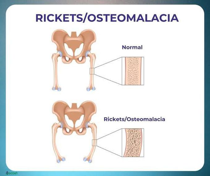 Osteomalacia